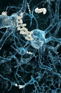 Alzheimers and Beta-amyloid plaques